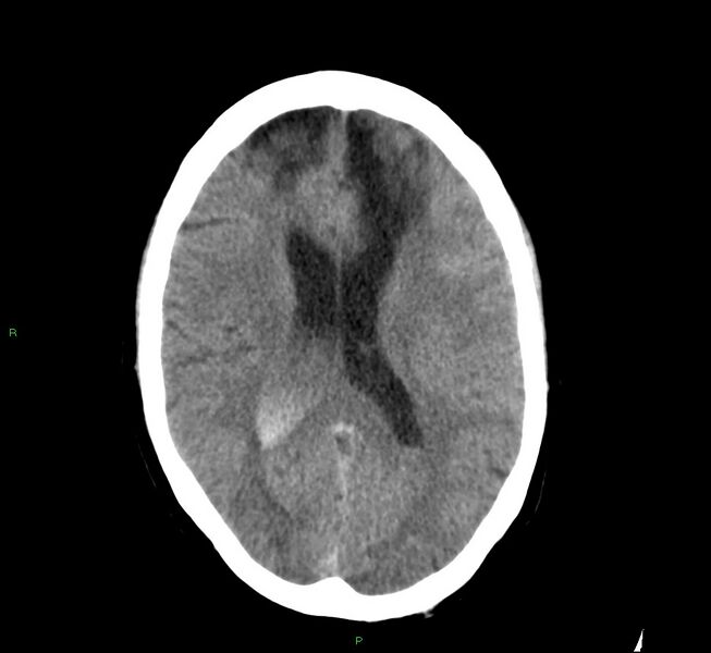 File:Cerebral amyloid angiopathy-associated lobar intracerebral hemorrhage (Radiopaedia 58529-65686 Axial non-contrast 15).jpg