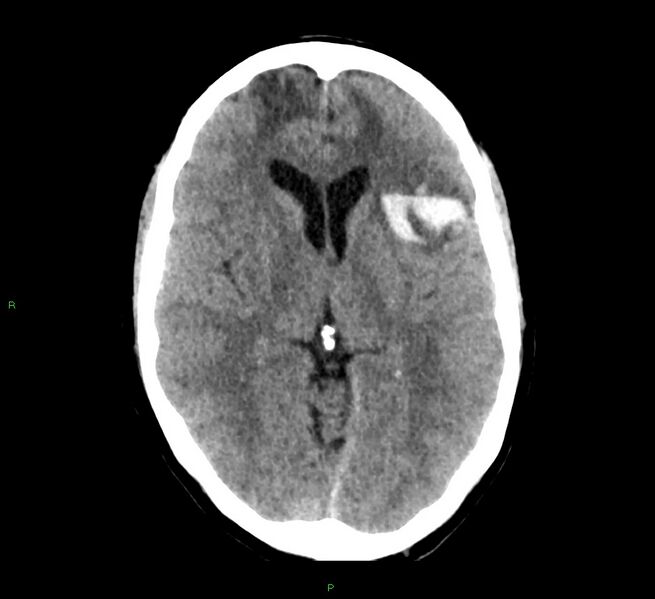 File:Cerebral amyloid angiopathy-associated lobar intracerebral hemorrhage (Radiopaedia 58529-65687 Axial non-contrast 28).jpg