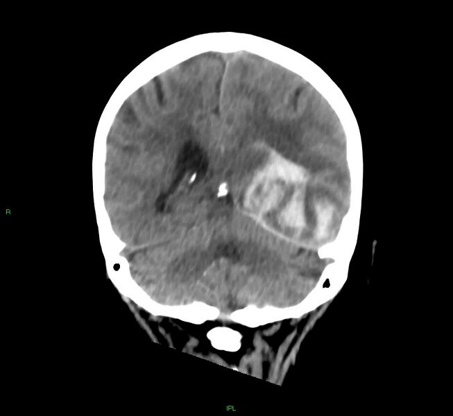 File:Cerebral amyloid angiopathy-associated lobar intracerebral hemorrhage (Radiopaedia 58754-65975 Coronal non-contrast 24).jpg