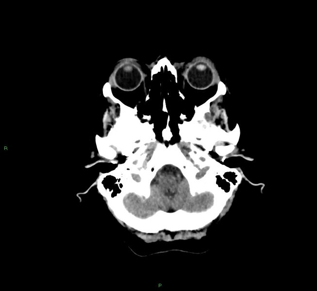 File:Cerebral amyloid angiopathy-associated lobar intracerebral hemorrhage (Radiopaedia 58757-65978 Axial non-contrast 43).jpg