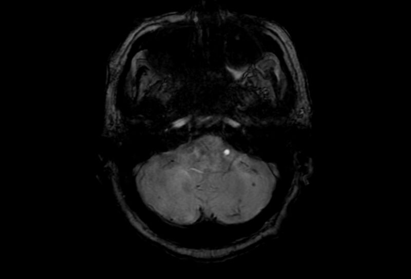 File:Cerebral amyloid angiopathy (Radiopaedia 86671-102792 Axial Gradient Echo 47).jpg