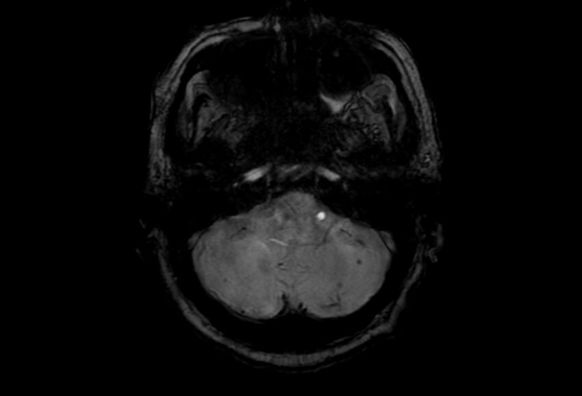 Cerebral amyloid angiopathy (Radiopaedia 86671-102792 Axial Gradient Echo 47).jpg