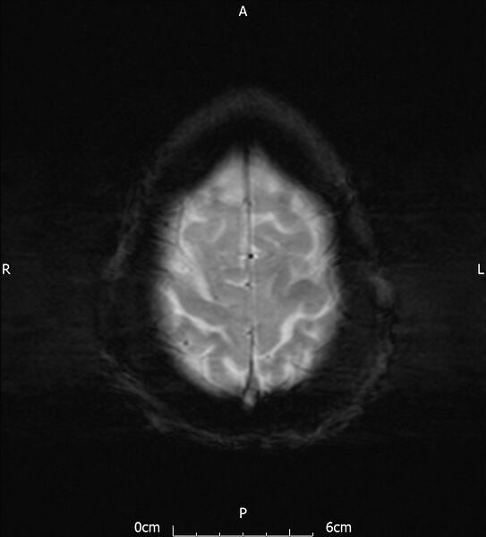 File:Cerebral amyloid angiopathy related inflammation (Radiopaedia 72772-83415 Axial SWI 21).jpg