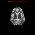 Cerebral and orbital tuberculomas (Radiopaedia 13308-13311 Axial DWI 29).jpg