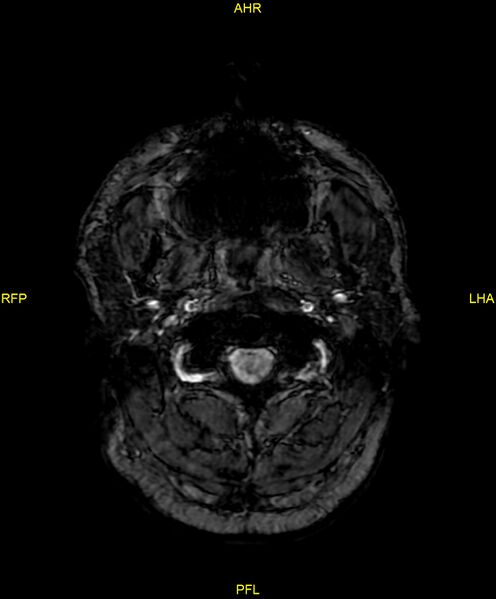 File:Cerebral autosomal dominant arteriopathy with subcortical infarcts and leukoencephalopathy (CADASIL) (Radiopaedia 86108-102054 Axial SWI 1).jpg