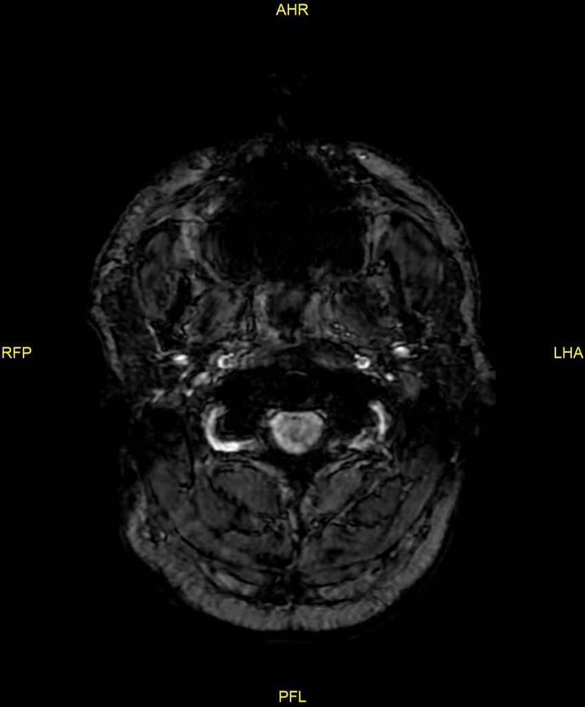 Cerebral autosomal dominant arteriopathy with subcortical infarcts and leukoencephalopathy (CADASIL) (Radiopaedia 86108-102054 Axial SWI 1).jpg