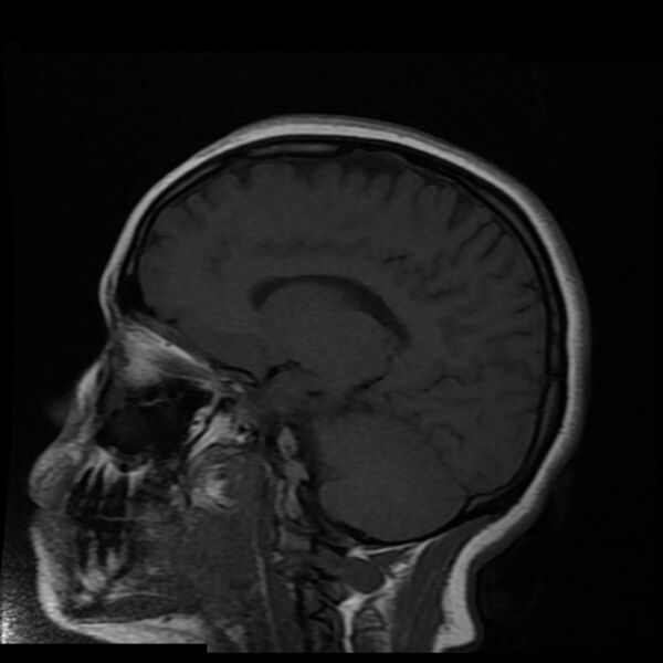 File:Cerebral cavernous malformation (Radiopaedia 44301-47942 Sagittal T1 8).jpg