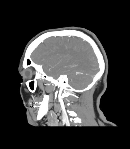 File:Cerebral dural venous sinus thrombosis (Radiopaedia 86514-102576 C 11).jpg