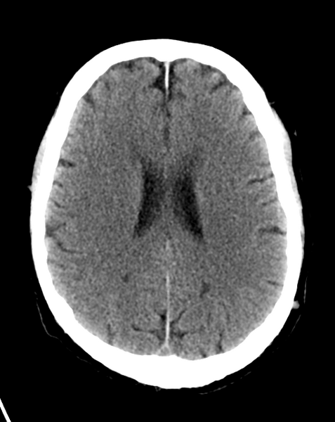 File:Cerebral embolic infarcts (embolic shower) (Radiopaedia 57395-64341 Axial non-contrast 20).png