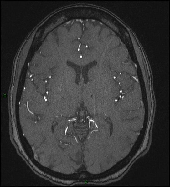 File:Cerebral fat embolism (Radiopaedia 35022-36525 Axial TOF 108).jpg