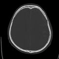Cerebral hemorrhagic contusions (Radiopaedia 23145-23188 Axial bone window 38).jpg