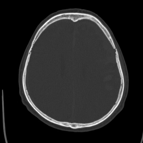 File:Cerebral hemorrhagic contusions (Radiopaedia 23145-23188 Axial bone window 38).jpg