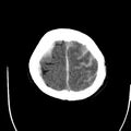Cerebral hemorrhagic contusions (Radiopaedia 23145-23188 Axial non-contrast 36).jpg
