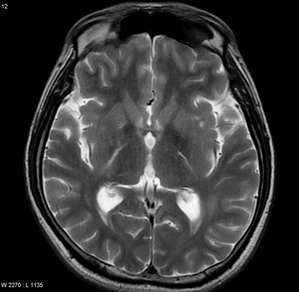File:Cerebral vasculitis (Radiopaedia 5131-6923 Axial T2 3).jpg