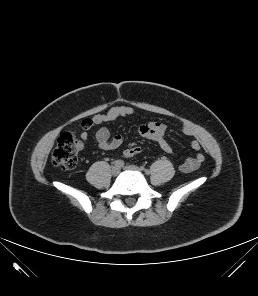 File:Cervical aortic arch with coarctation and aneurysms (Radiopaedia 44035-47552 Axial non-contrast 74).jpg