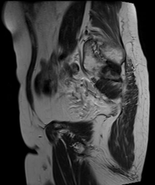 File:Cervical carcinoma (Radiopaedia 88312-104943 Sagittal T2 22).jpg