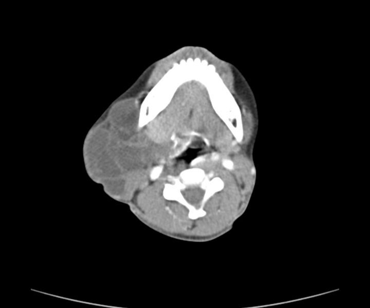 File:Cervical cystic lymphangioma (Radiopaedia 63655-72332 Axial + contrast 14).jpg