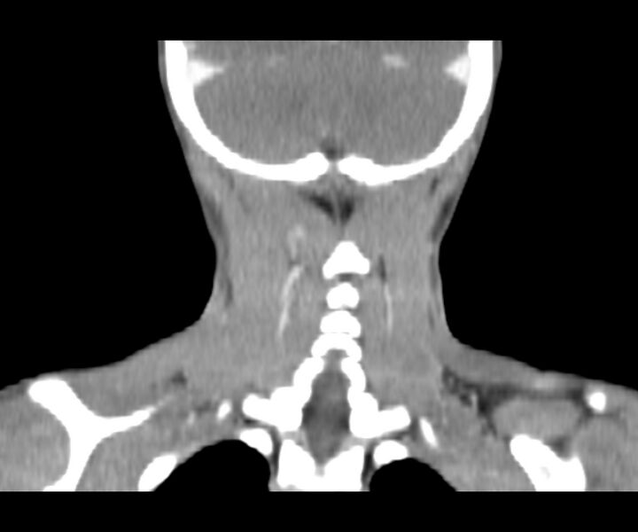 File:Cervical cystic lymphangioma (Radiopaedia 63655-72332 Coronal + contrast 29).jpg