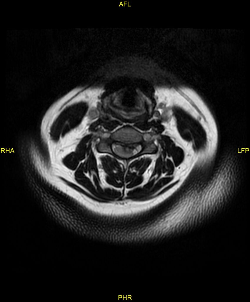 Cervical disc protrusion (Radiopaedia 87147-103415 Axial T2 14).jpg