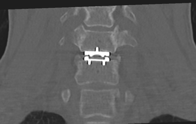 File:Cervical disc replacement (Radiopaedia 37383-39205 Coronal bone window 30).png
