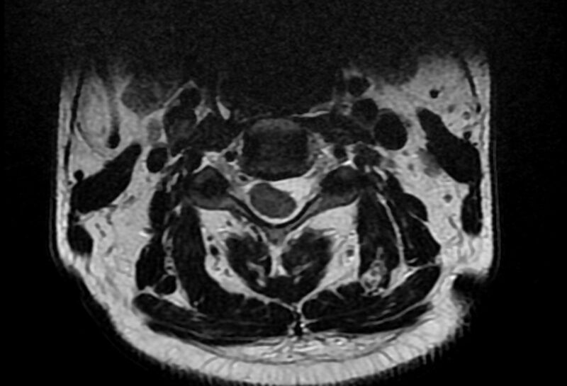 File:Cervical schwannoma (Radiopaedia 72399-82934 Axial T2 5).jpg