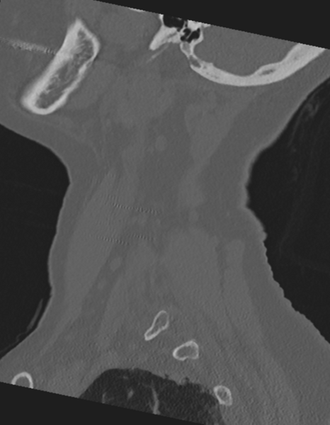 File:Cervical spine ACDF loosening (Radiopaedia 48998-54071 Sagittal bone window 17).png