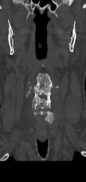 File:Cervical spine fracture - chalk stick (Radiopaedia 39116-41323 Coronal bone window 11).png