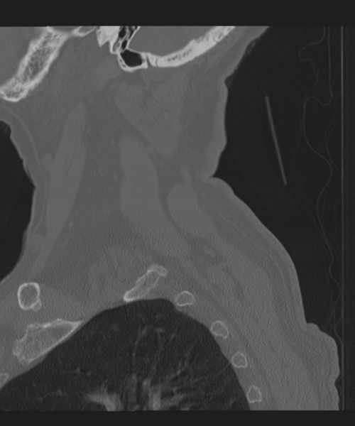 File:Cervical spine fracture in the setting of ankylosis (Radiopaedia 37038-38715 Sagittal bone window 9).png