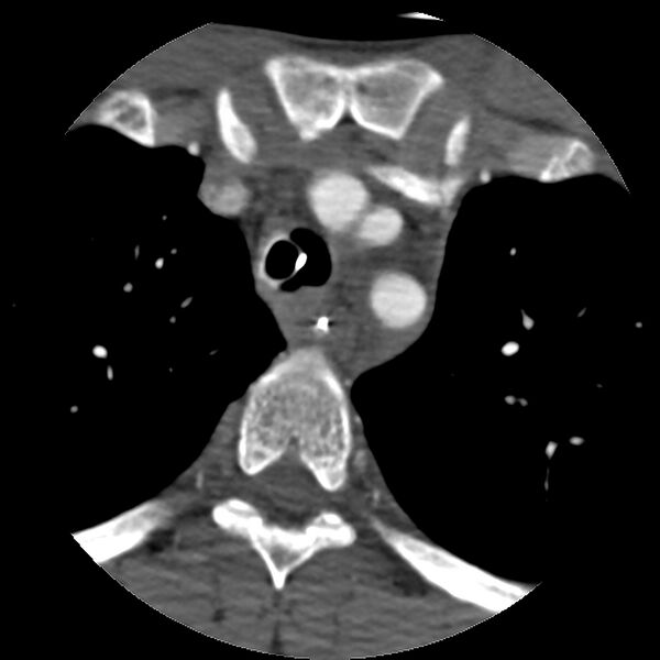 File:Cervical spine fractures with vertebral artery dissection (Radiopaedia 32135-33078 D 3).jpg