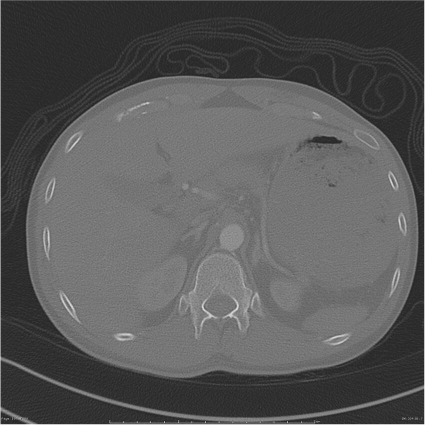 Chest and abdomen multi-trauma (Radiopaedia 26294-26425 bone window 104).jpg