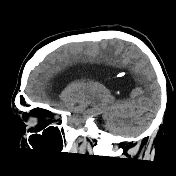 File:Chiasmatic-hypothalamic juvenile pilocytic astrocytoma (Radiopaedia 78533-91237 B 40).jpg