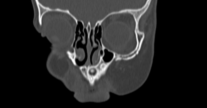 Choanal atresia (Radiopaedia 51295-56972 Coronal bone window 2).jpg