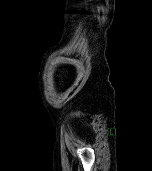 File:Cholangiocarcinoma with cerebral metastases (Radiopaedia 83519-98629 F 110).jpg