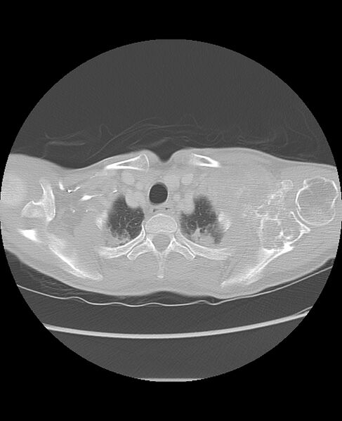 File:Chondrosarcoma (Radiopaedia 79427-92532 Axial lung window 6).jpg