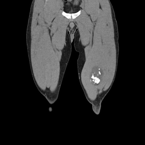 File:Chondrosarcoma arising from exostosis (Radiopaedia 59996-67507 Coronal soft tissue 3).jpg