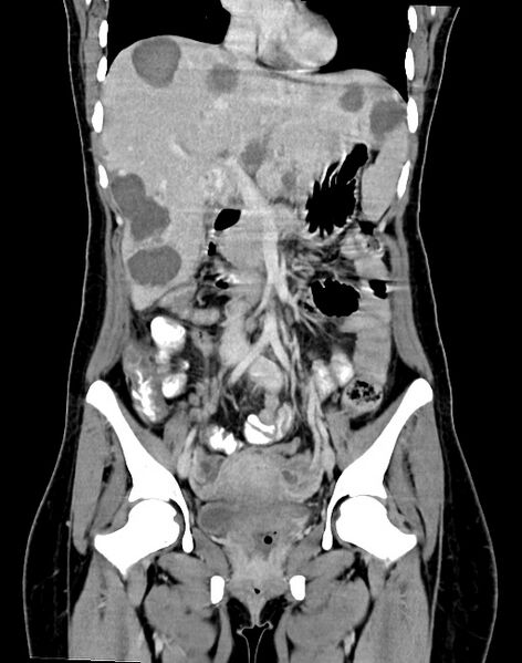 File:Choriocarcinoma liver metastases (Radiopaedia 74768-85766 B 49).jpg