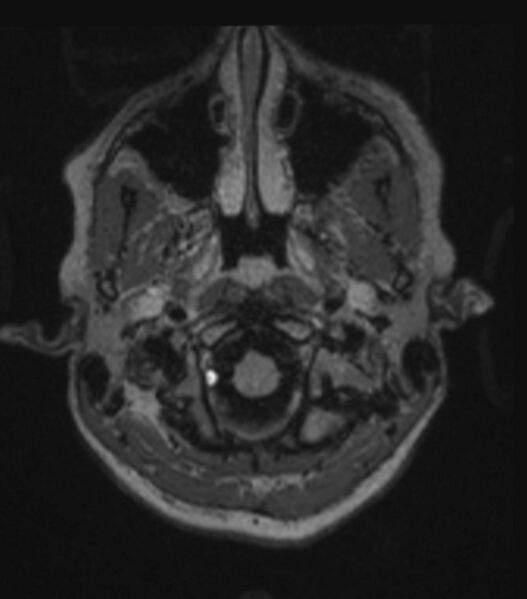 File:Choroid plexus carcinoma (Radiopaedia 91013-108553 Axial FLAIR C+ 76).jpg