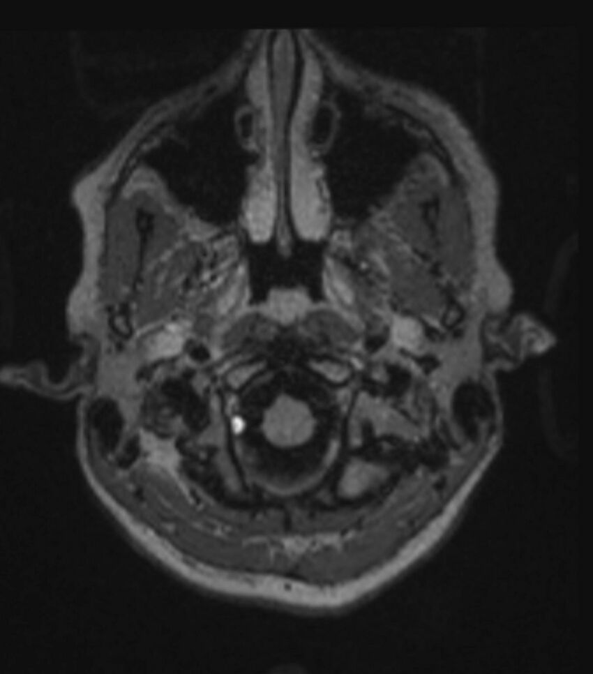 Choroid plexus carcinoma (Radiopaedia 91013-108553 Axial FLAIR C+ 76).jpg