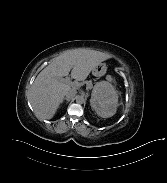 File:Chromophobe renal cell carcinoma (Radiopaedia 84239-99519 Axial non-contrast 55).jpg