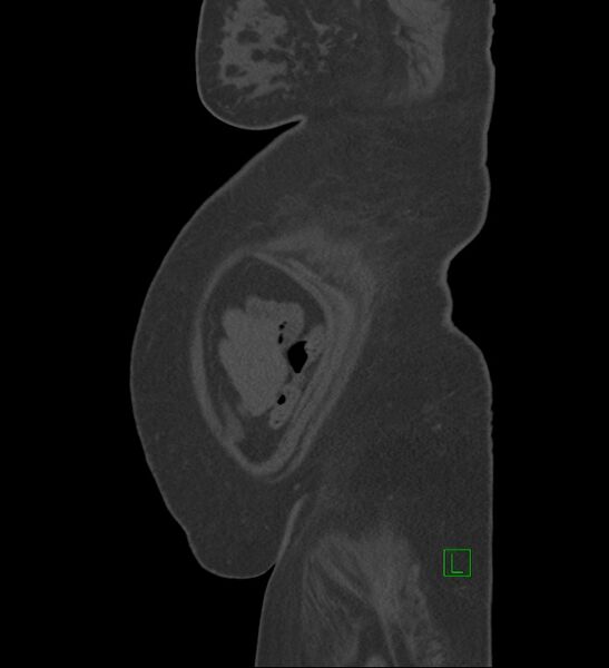 File:Chromophobe renal cell carcinoma (Radiopaedia 84239-99519 Sagittal bone window 3).jpg