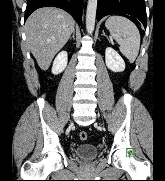File:Chromophobe renal cell carcinoma (Radiopaedia 84286-99573 H 118).jpg