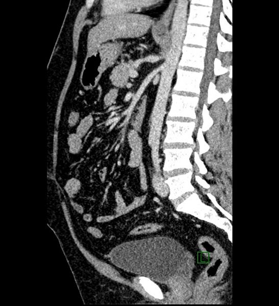 File:Chromophobe renal cell carcinoma (Radiopaedia 84286-99573 I 85).jpg
