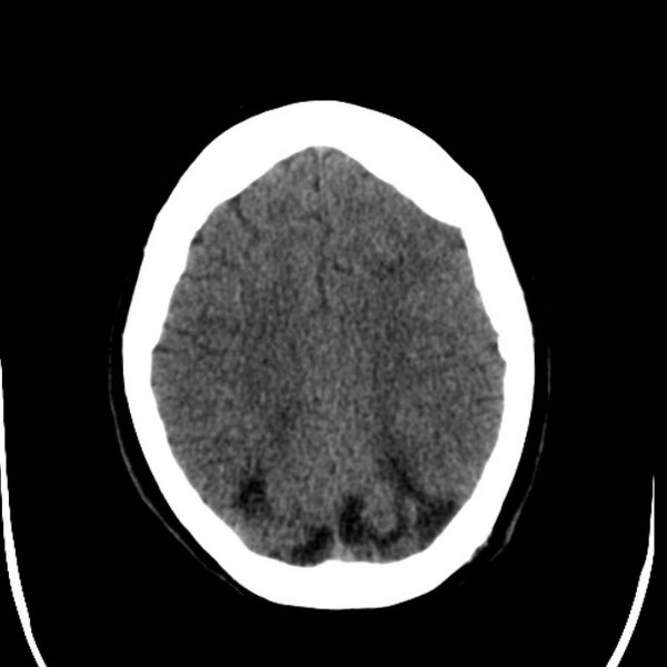 File:Chronic bilateral occipital lobe infarcts (Radiopaedia 31276-31996 Axial non-contrast 31).jpg