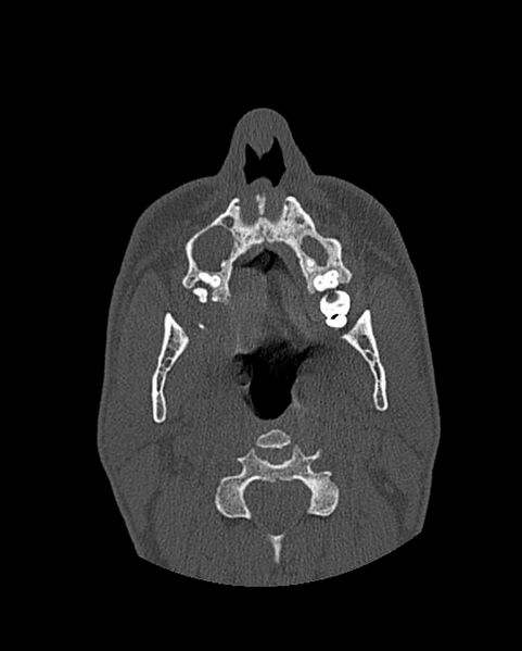 File:Chronic maxillary sinusitis caused by a foreign body (Radiopaedia 58521-65676 Axial bone window 50).jpg