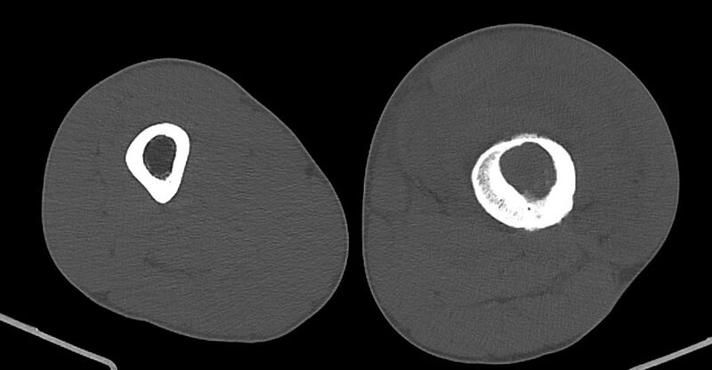 File:Chronic osteomyelitis (with sequestrum) (Radiopaedia 74813-85822 Axial non-contrast 107).jpg