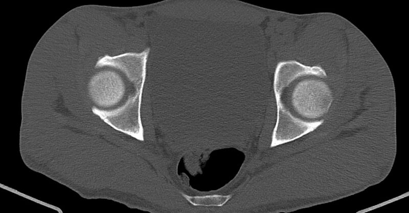File:Chronic osteomyelitis (with sequestrum) (Radiopaedia 74813-85822 Axial non-contrast 32).jpg