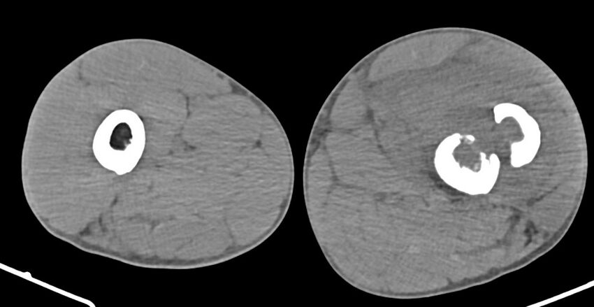 Chronic osteomyelitis (with sequestrum) (Radiopaedia 74813-85822 D 86).jpg