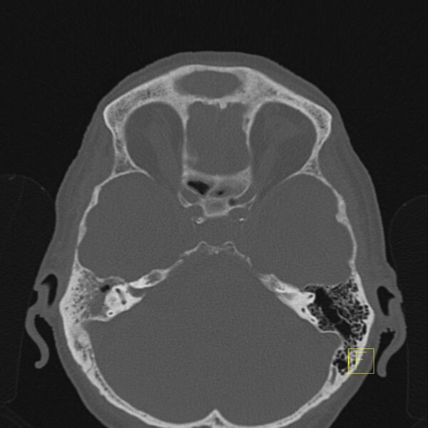 File:Chronic otitis media (Radiopaedia 14994-14912 Axial bone window 3).JPEG