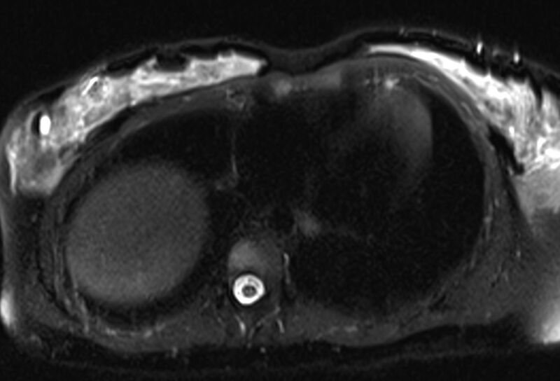 File:Chronic pancreatitis - pancreatic duct calculi (Radiopaedia 71818-82250 Axial T2 fat sat 1).jpg