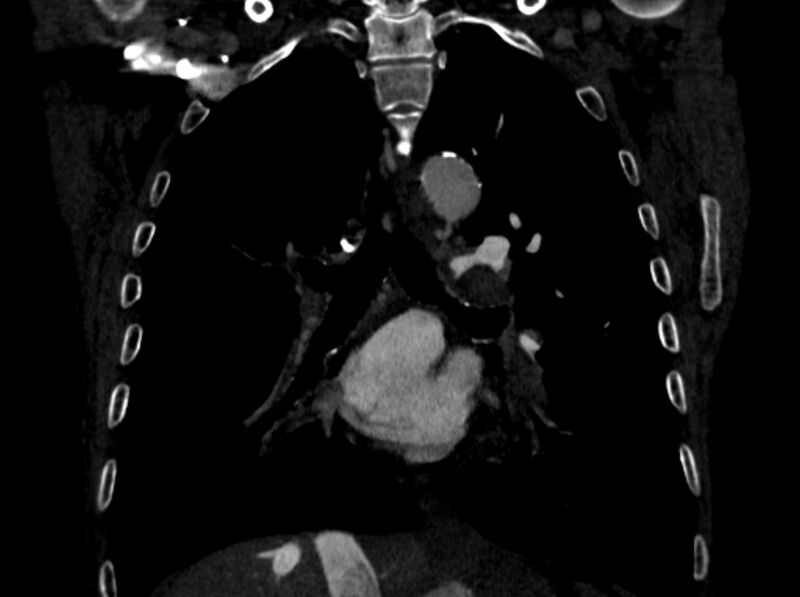 File:Chronic pulmonary embolism (Radiopaedia 91241-108843 A 62).jpg